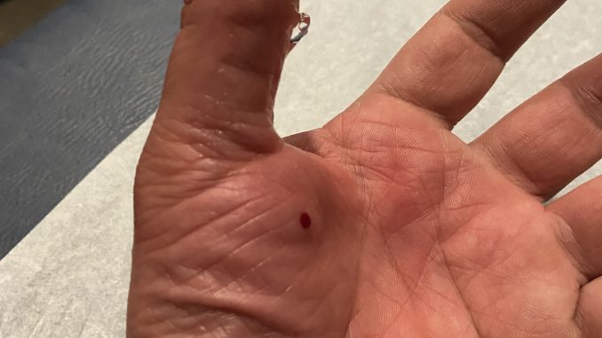 Trigger Thumb